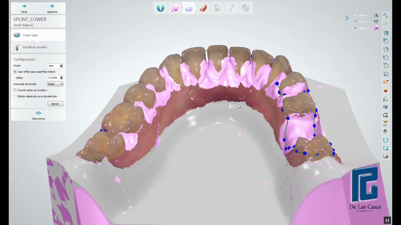 Férula de Michigan inferior, diseño 3Shape y impresión 3D con Formlab - DlCasas prótesis dental