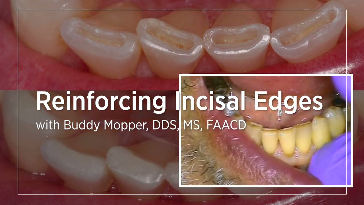 Reinforcing Incisal Edges