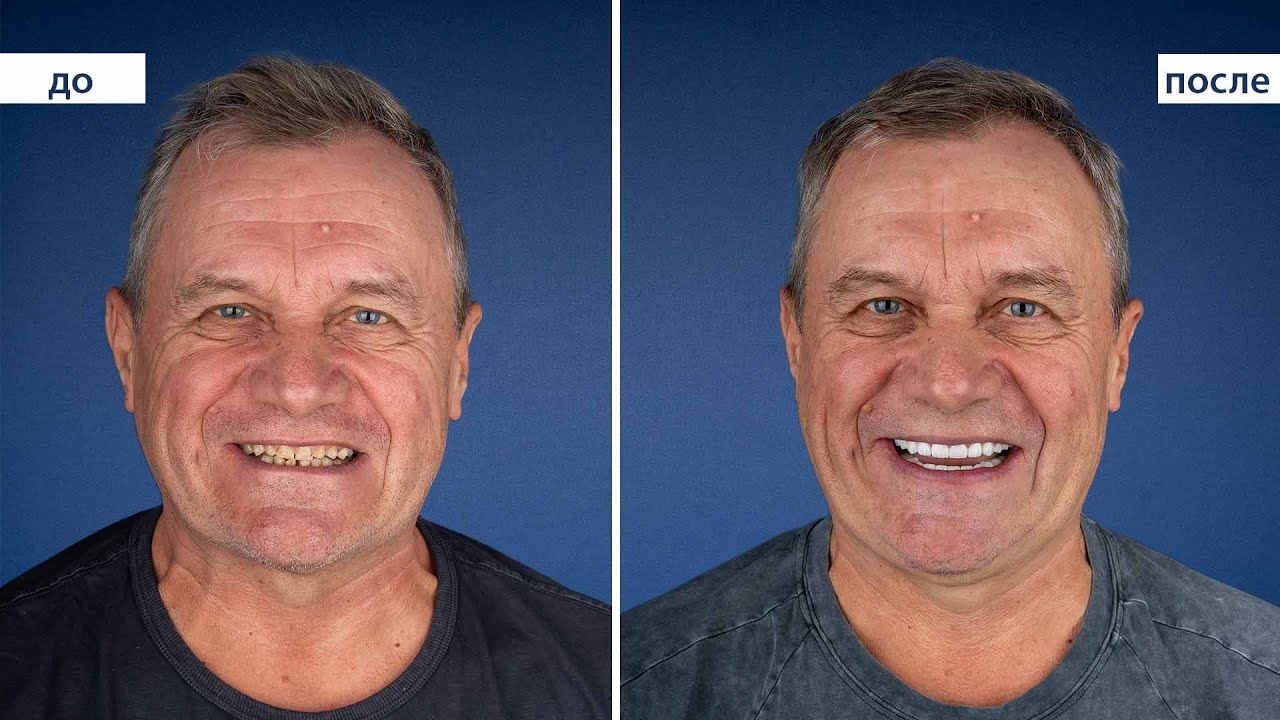 From New York to Istanbul  | Реальный опыт лечения зубов в Kristal Clinic (58 лет)