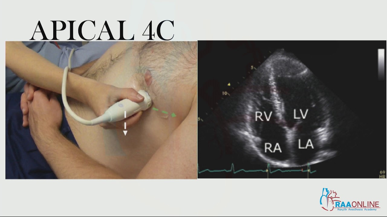 Apical four chamber and five chamber view