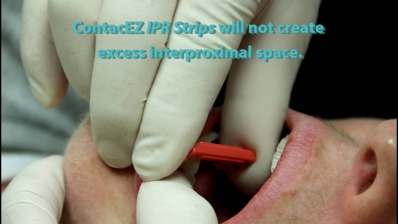 Using ContacEZ IPR Strips with Overlapping Teeth