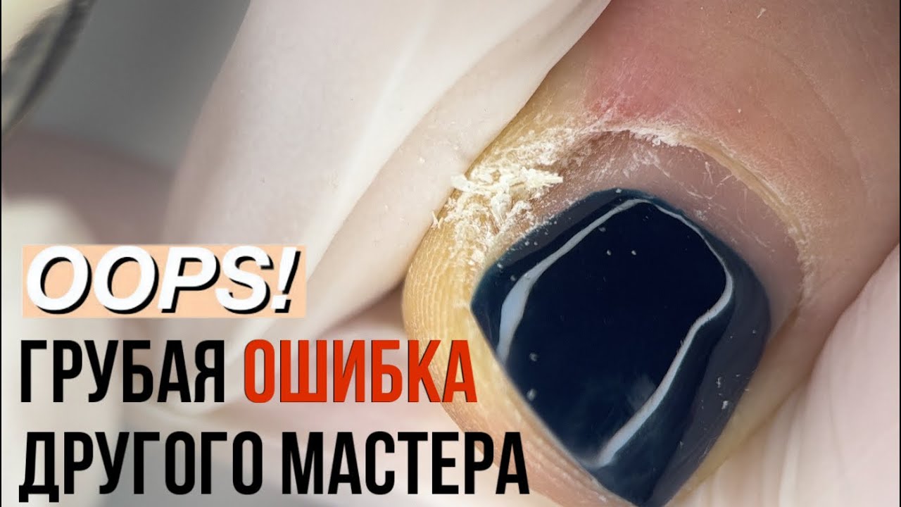 КАК МНЕ ЗАПОРОЛИ НОГТИ. Педикюр от другого мастера. Подногтевые мозоли. Вростание ногтей