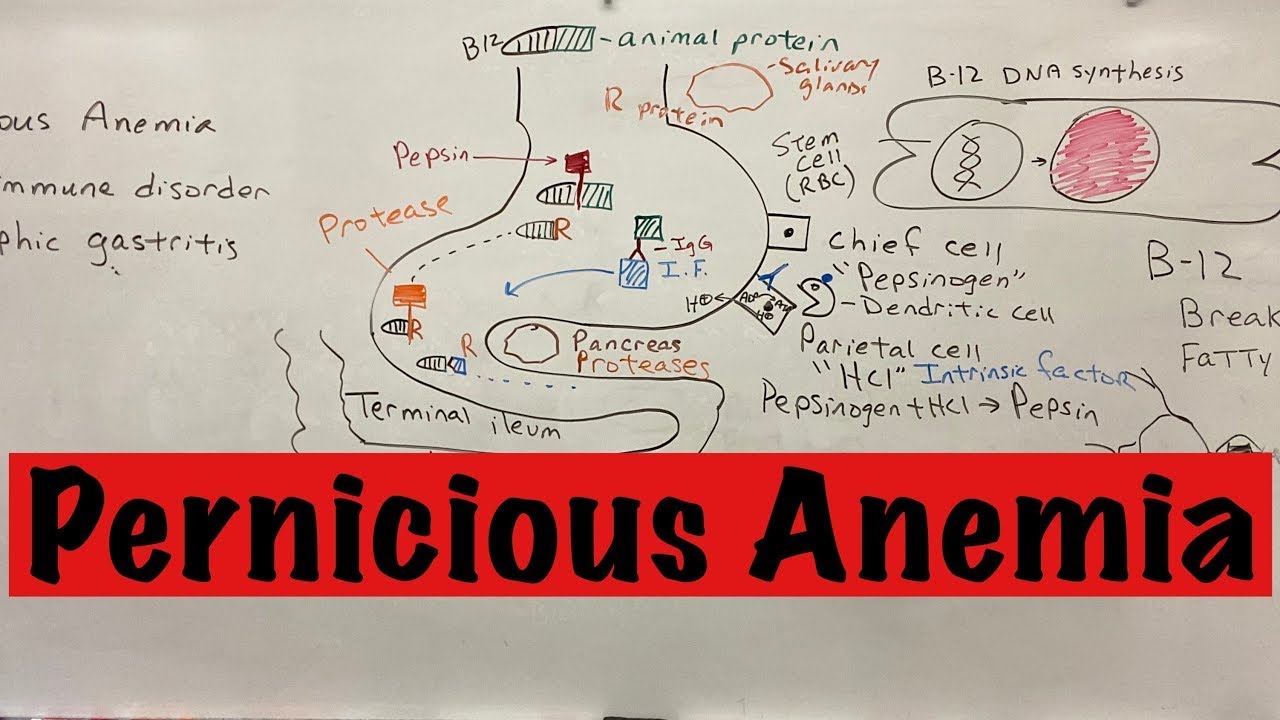 Pernicious Anemia A Simple Explanation