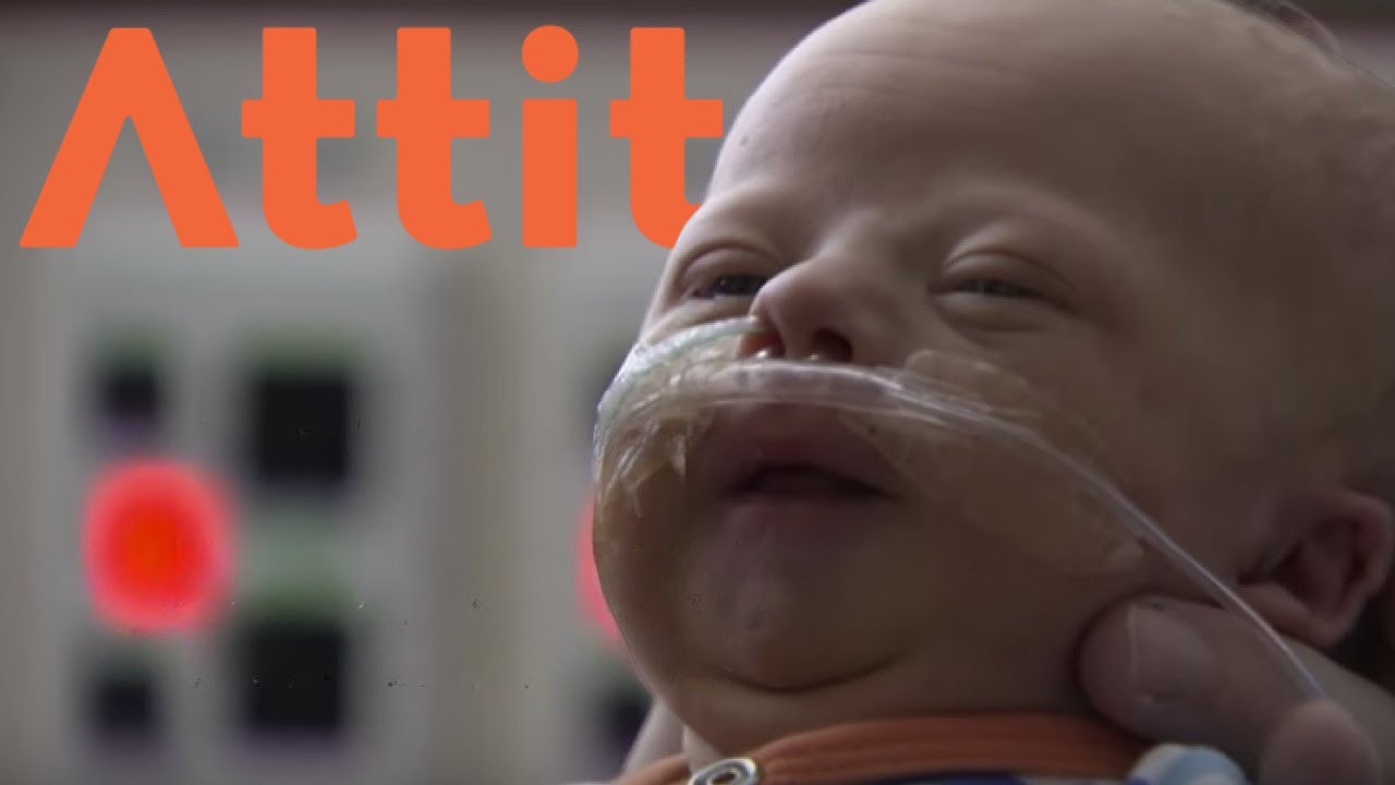 Raising a baby with Down Syndrome