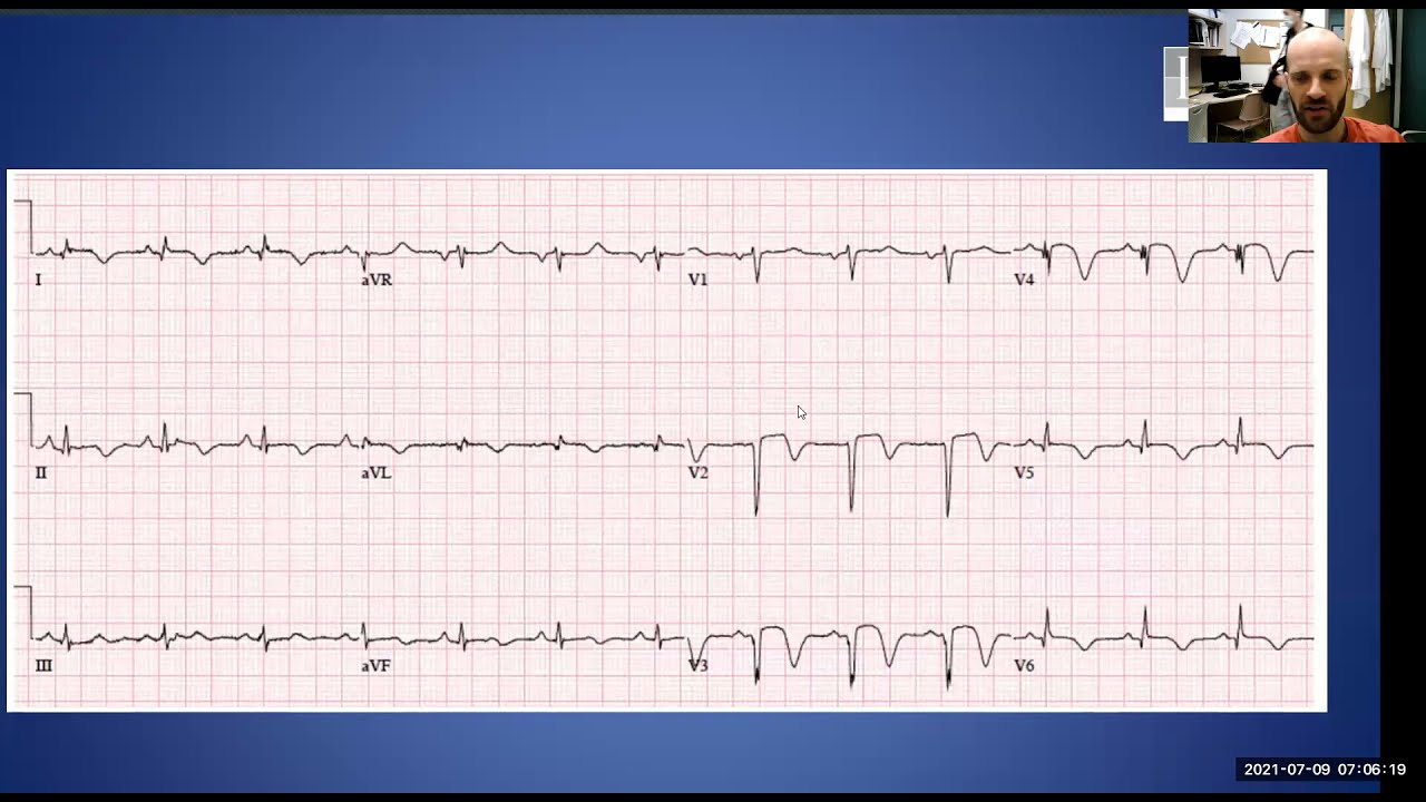 INTRODUCTION TO THE ECG | Session #4 | Conduction Disorders & Pacing