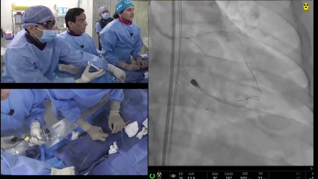 (20 min CCC Feb '19) Imaging Guided High Risk of LM Trifurcation LAD and LCx