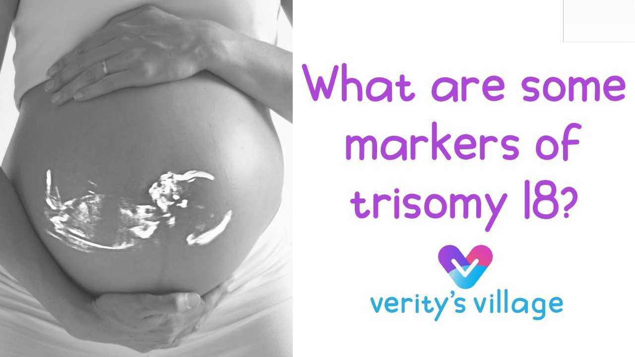 What are some common trisomy 18 markers?