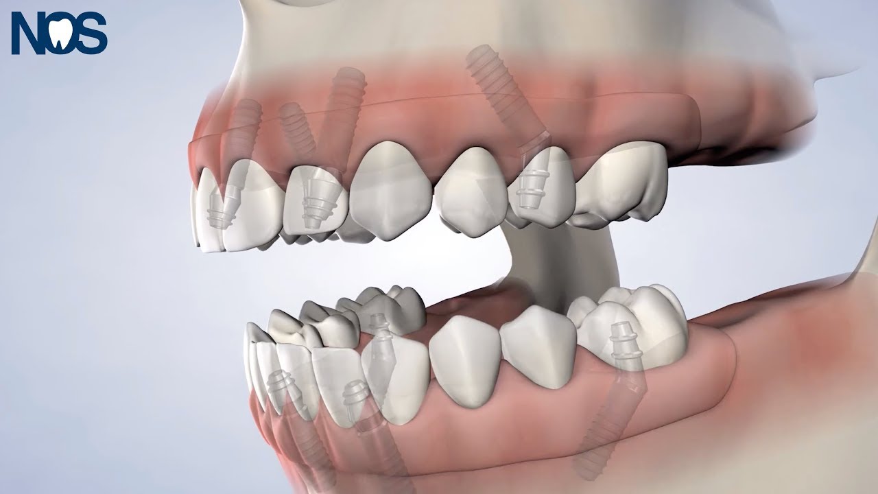 Post-Op Instructions: All-on-4® at Naperville Oral Surgery & Dental Implants