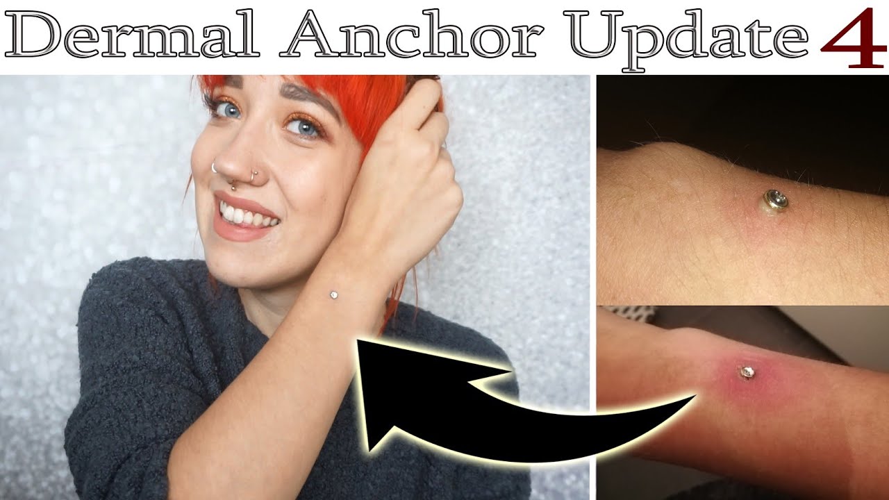 Dermal Anchor Drama & Update nach 8 Monaten 💉