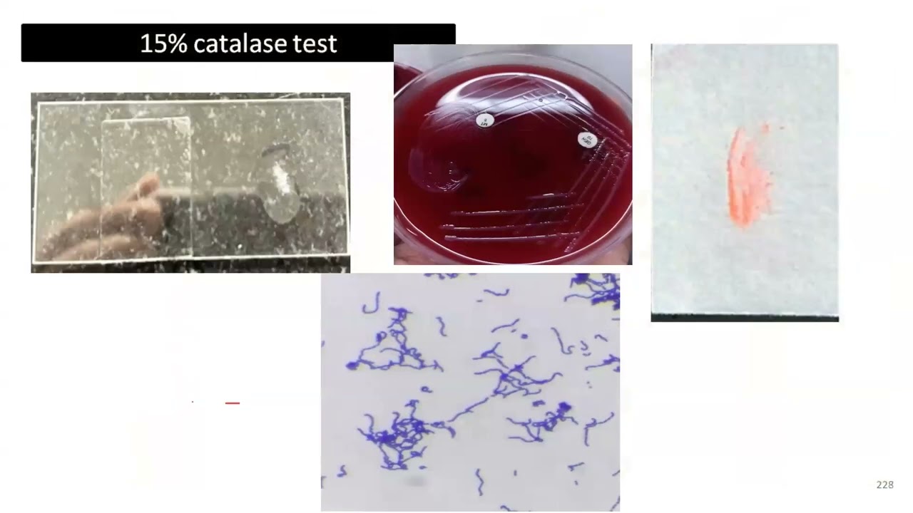 Infection Webinar Series : Clinical Case 2 Anaerobic Case Scenario Of Actinomyces in IUD user