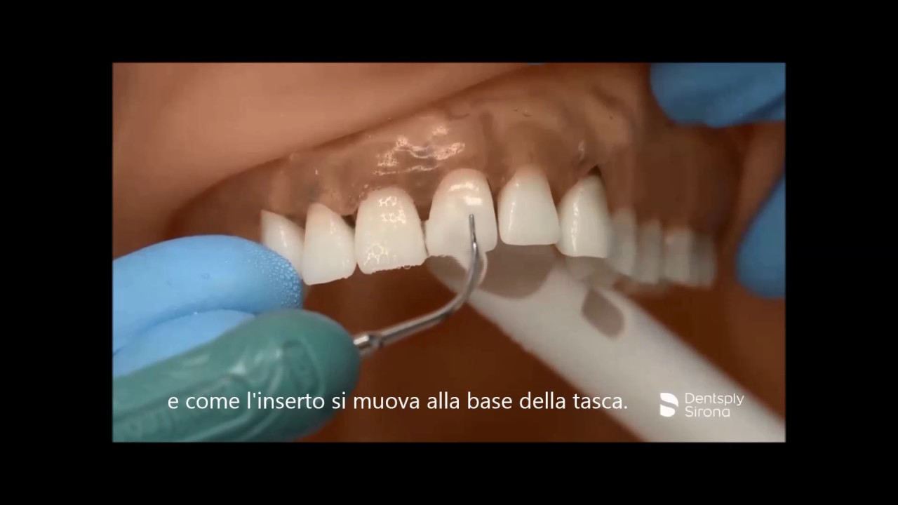Guida all'uso degli inserti ultrasonici Cavitron | Dentsply Sirona
