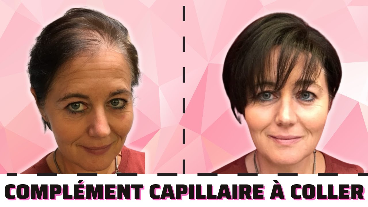Solution rapide à la Calvitie!!!