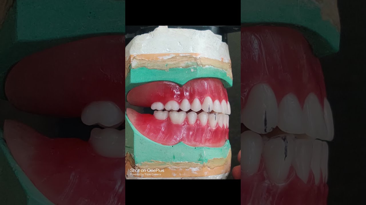 Balanced occlusion ,pre clinical teeth setting.@Dentisttobe61dentisttobe