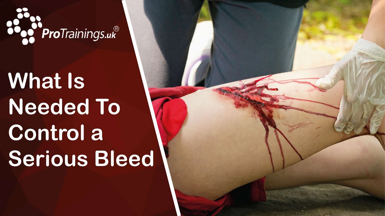 What is needed to control a serious bleed