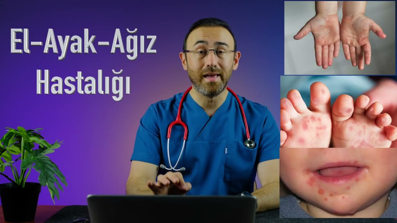 El Ayak Ağız Hastalığı Nedir? (Belirti, Korunma, Tedavi)