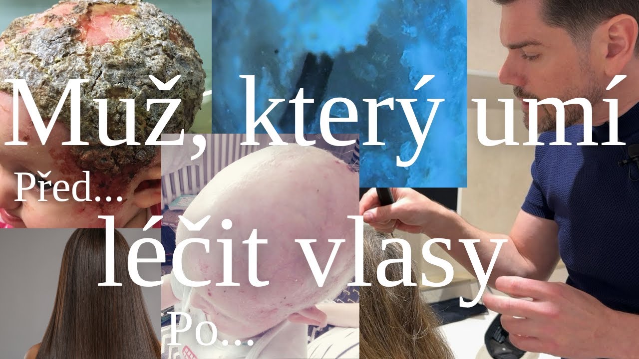 MUŽ, KTERÝ LÉČÍ VLASY. Dermotricholog Lukáš Rossbach. BORCI /podcast/