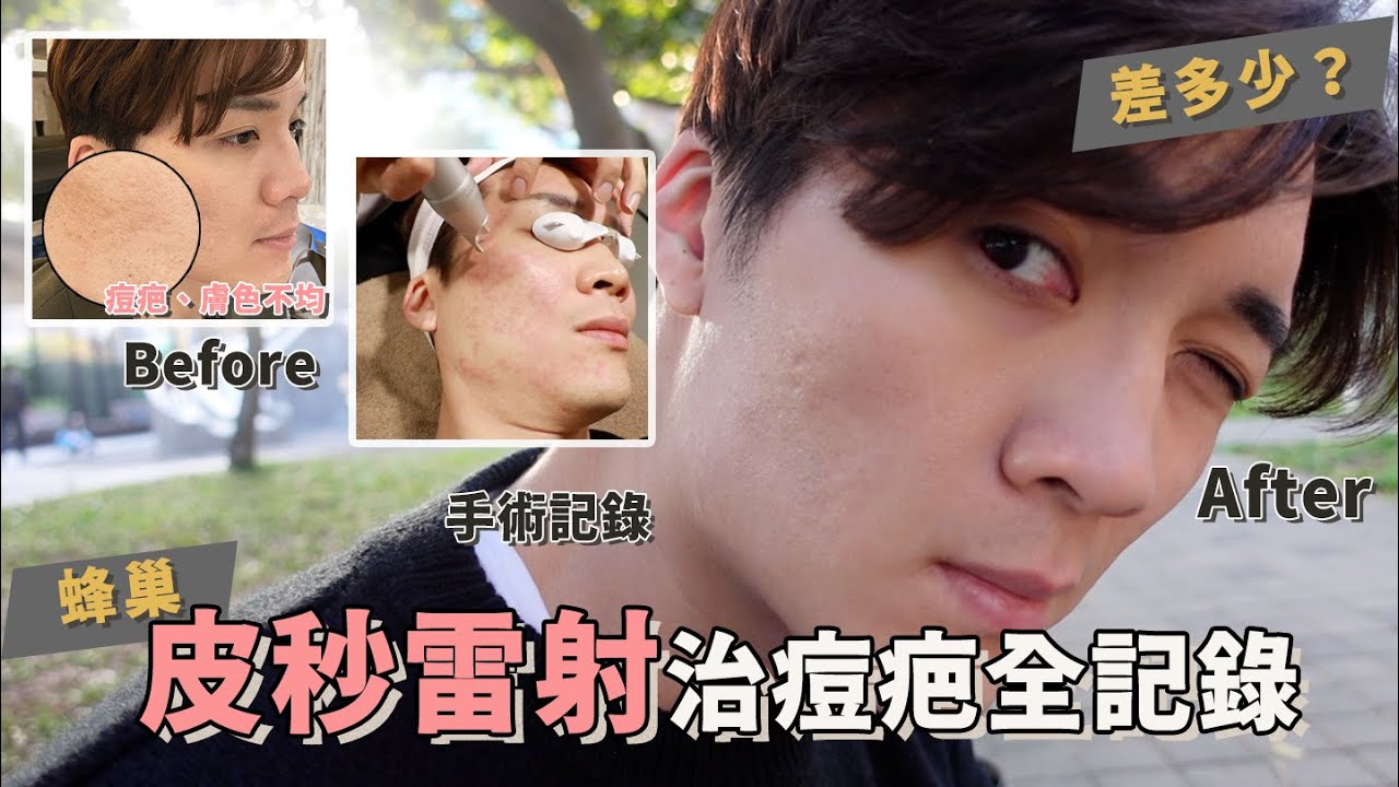痘斑、痘疤全治好？醫美真的能讓皮膚變好？皮秒雷射全記錄｜米鹿deerdeer