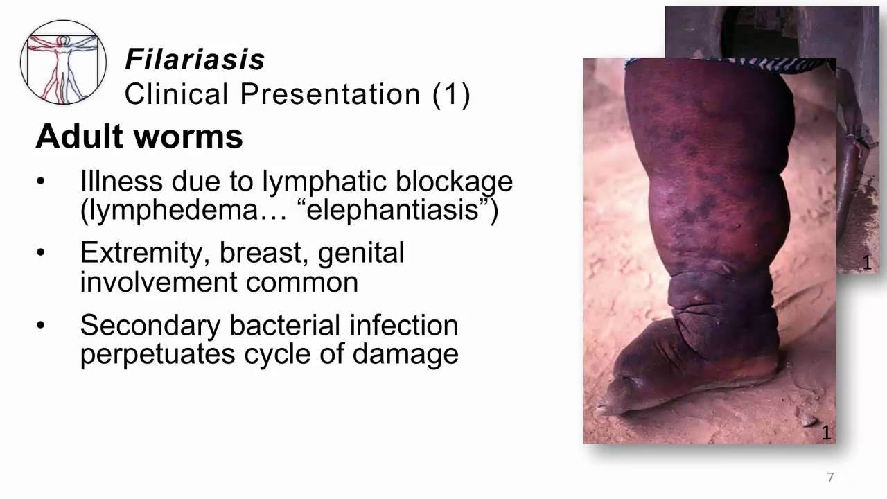 Helminths Filarisasis