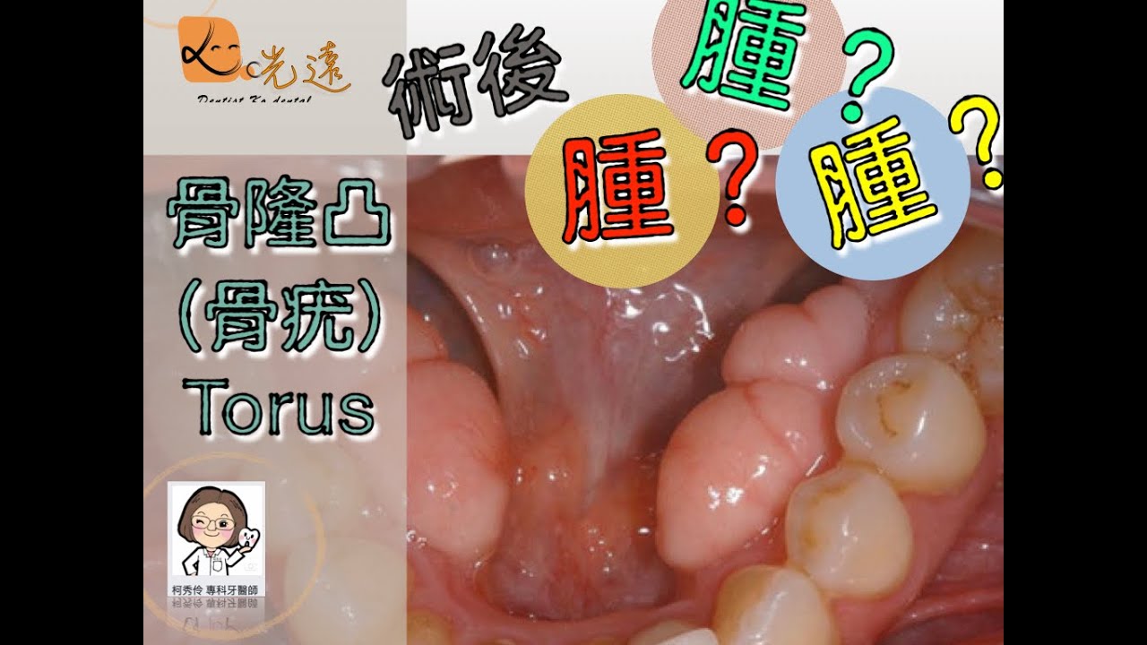 骨疣 光遠牙醫柯秀伶