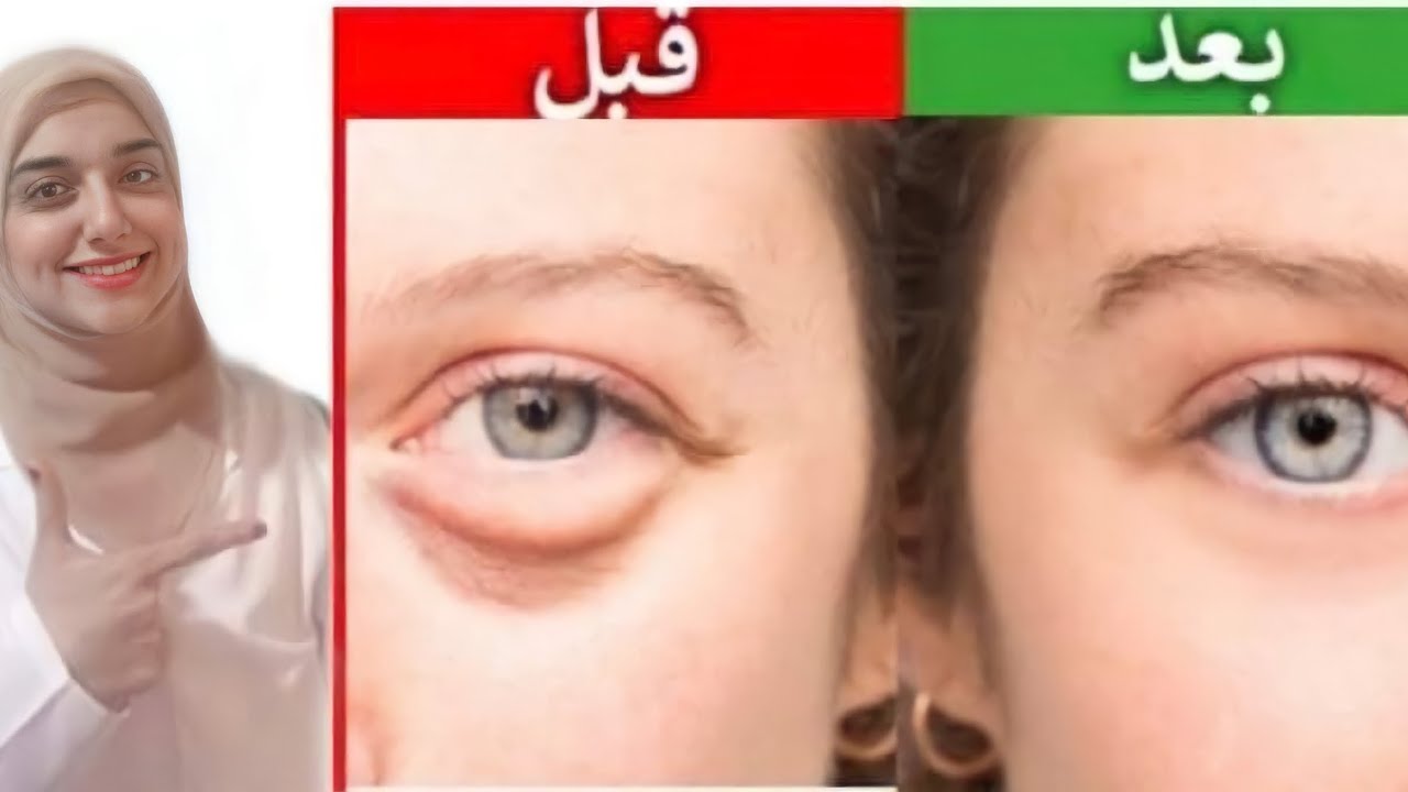وصفة طبيعية للتخلص من انتفاخات تحت العين في ١٠ دقائق