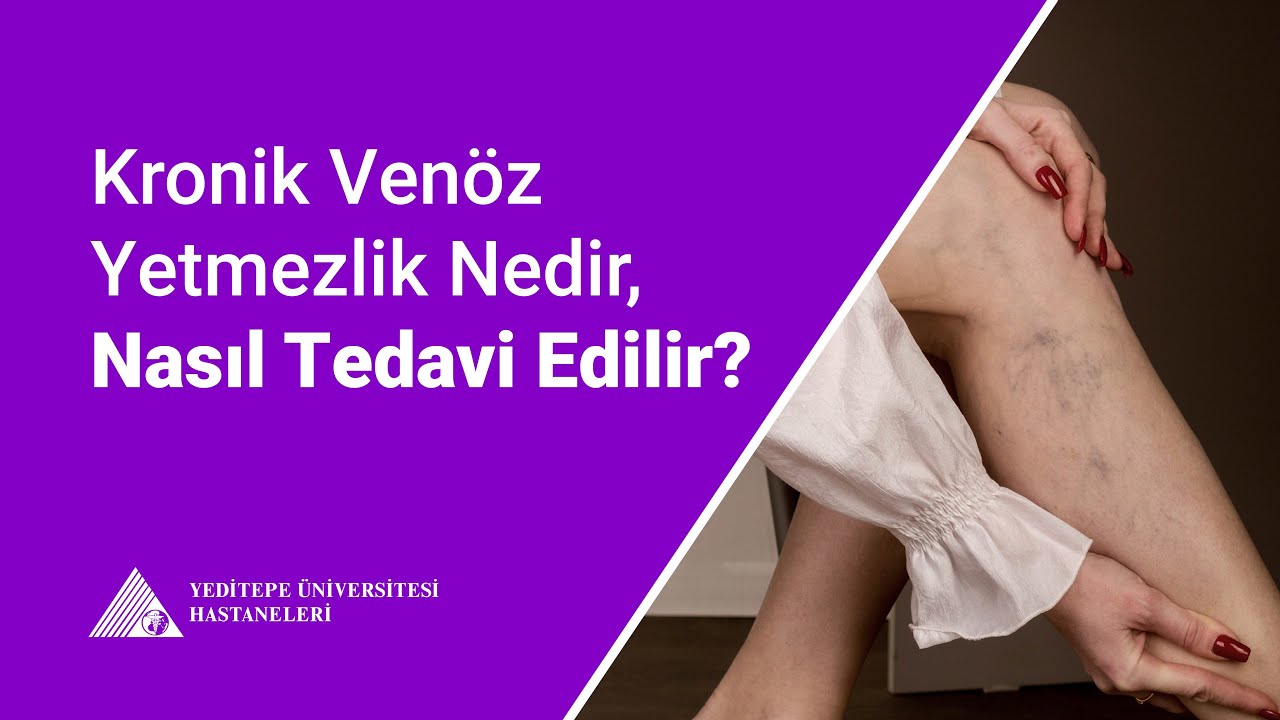Kronik Venöz Yetmezlik Nedir, Nasıl Tedavi Edilir? | Doç. Dr. Baran Şimşek