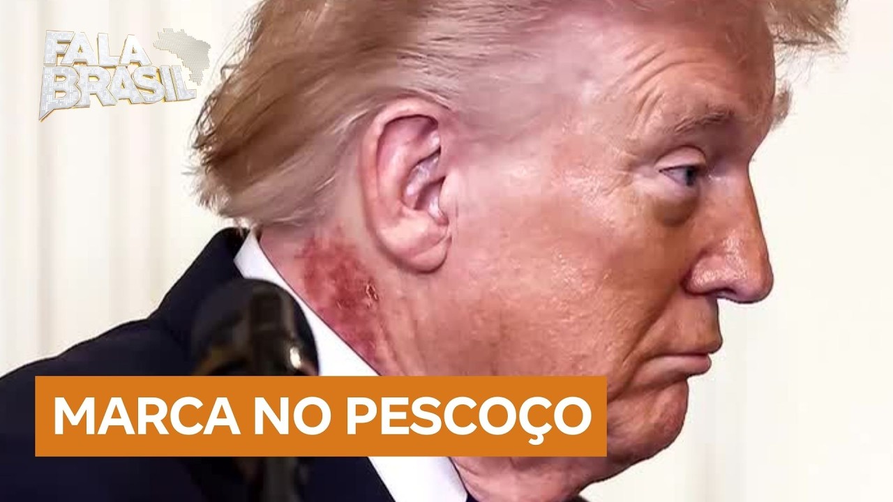 Hematoma no pescoço de Trump é resultado de tratamento preventivo, diz médico