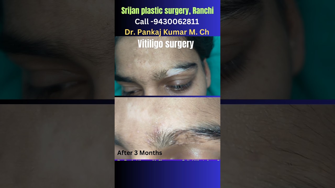 Vitiligo surgery | Correction of white spot | Vitiligo white spot treatment in Ranchi #vitiligo