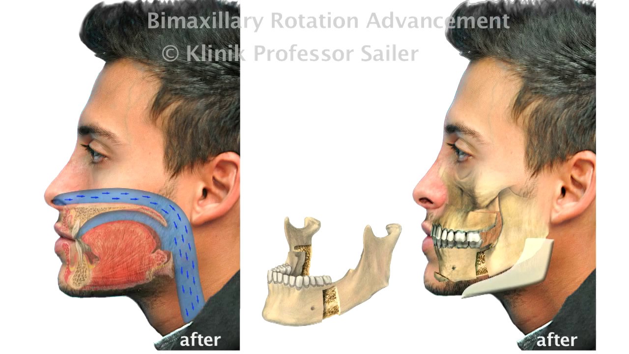 Sleep Apnea surgery cures forever