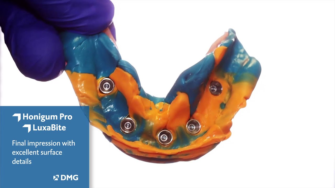 Full Implant Impression Technique: LuxaBite & Honigum Pro