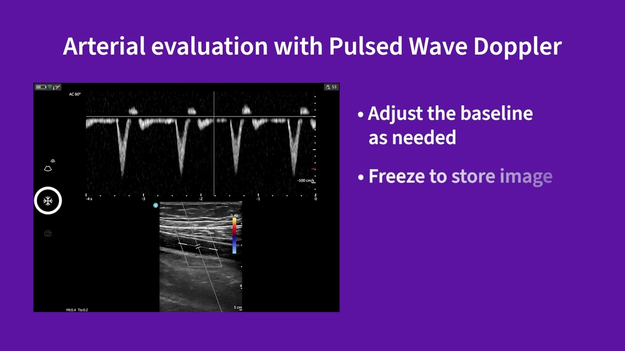 Vscan Air™ | Using preset for arterial evaluation