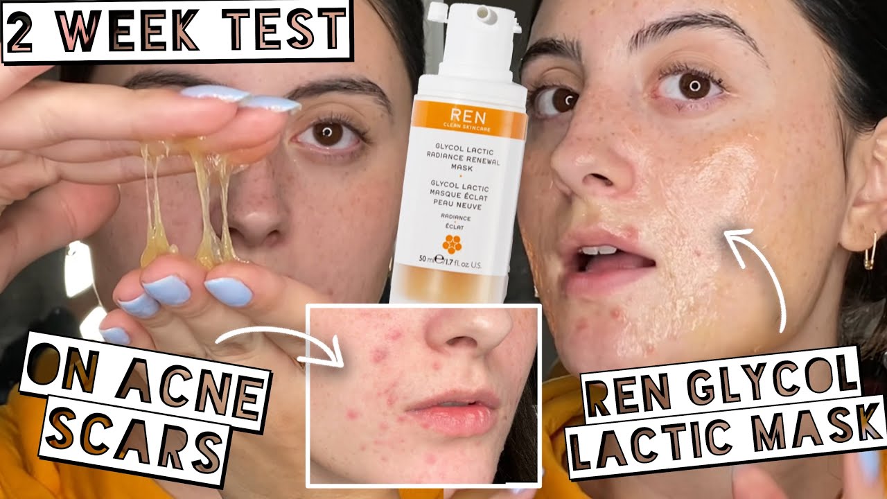 TESTING $58 REN GLYCOL LATIC RADIANCE RENEWAL MASK FOR 2 WEEKS FOR ACNE SCARS