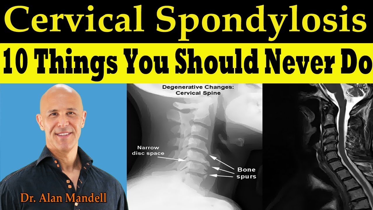 CERVICAL SPONDYLOSIS 10 Things You Should Never Do -  Dr. Alan Mandell, DC