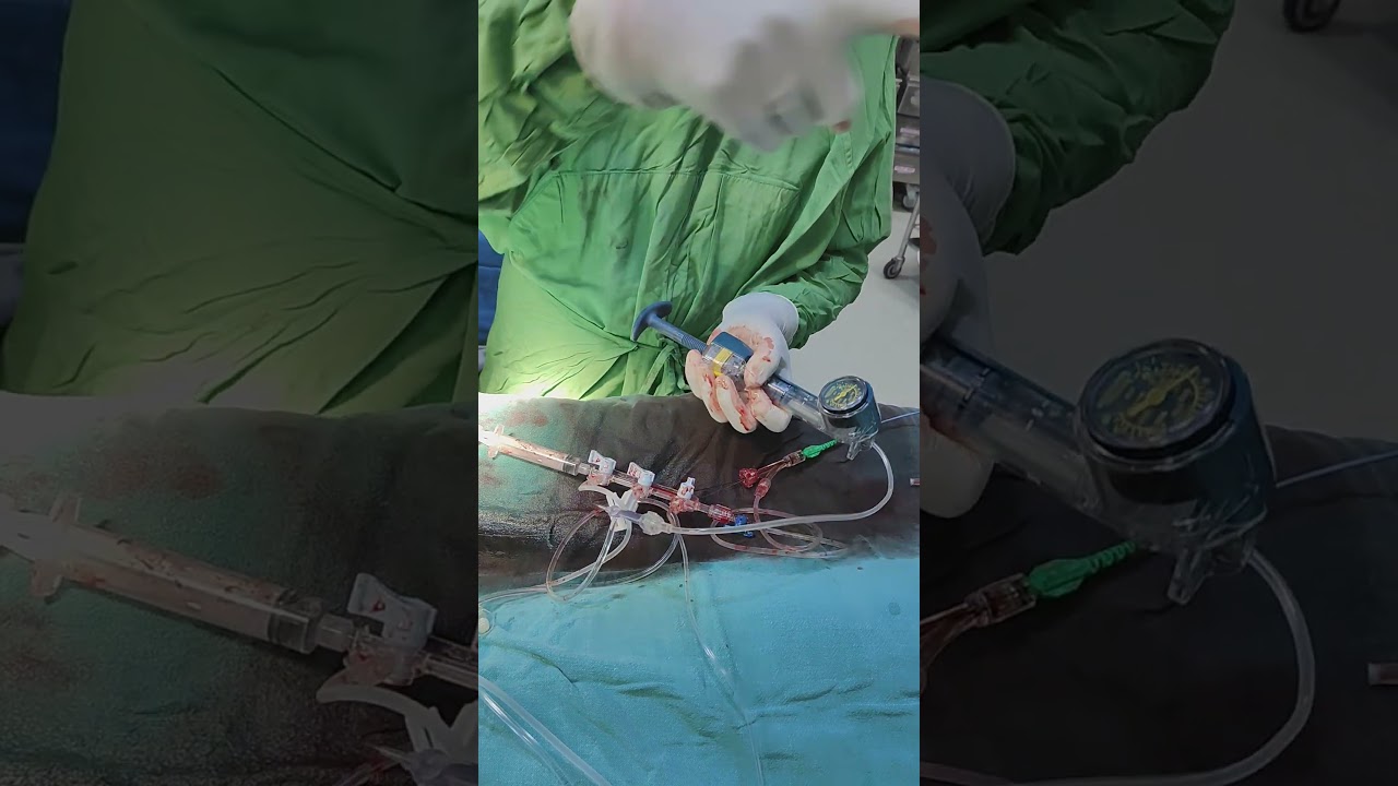 Critical Stenosis PDA and Ramus branch Stented Prof Dr Vivek Gupta a6.1.26