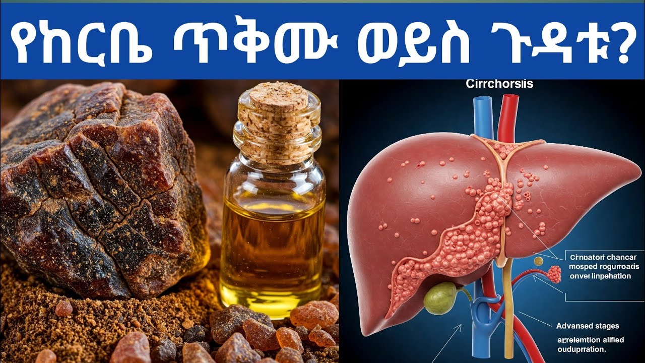 የከርቤ ጥቅሙ ወይስ ጉዳቱ ይበልጣል? የከርቤ ጥቅምና ጉዳት| does myrrh have more benefits or drawbacks?