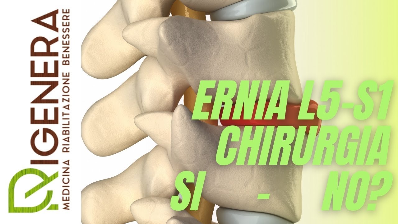 ERNIA L5-S1: quando operare? il mio punto di vista....