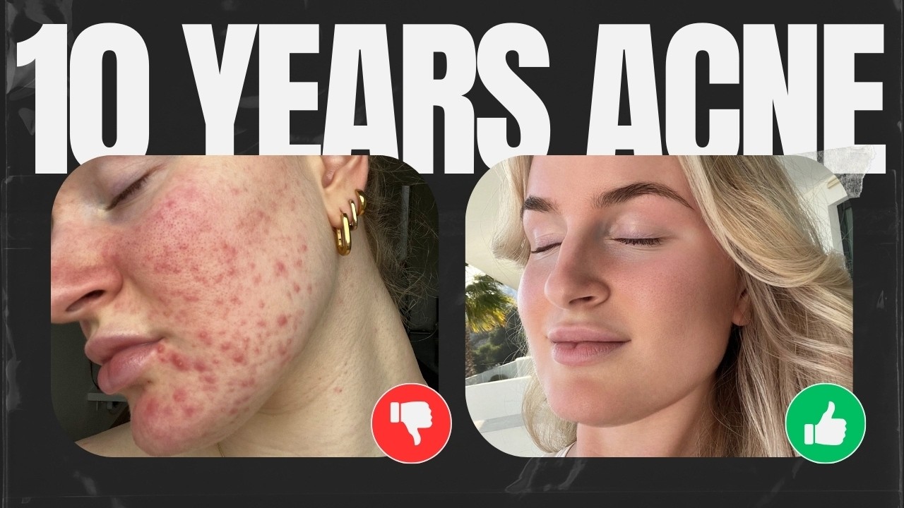 10 Years of Acne: How I Finally Cleared My Skin