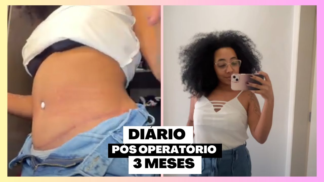 3 MESES DE PÓS OPERATÓRIO - ABDOMINOPLASTIA | Talita Oliveira