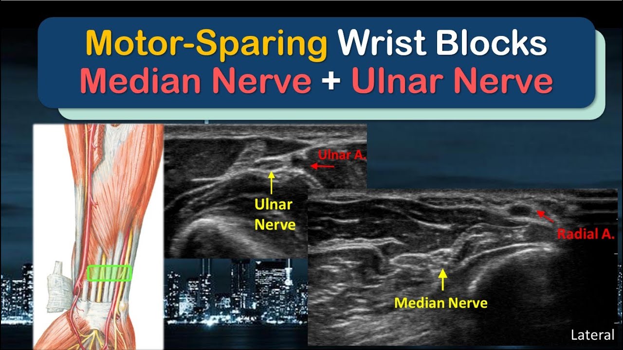 Motor-sparing MEDIAN and ULNAR NERVE blocks at the WRIST - a 