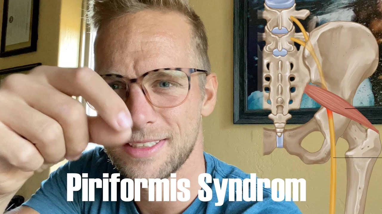 Meine Hüfte geht mir auf den Nerv - Piriformis Syndrome