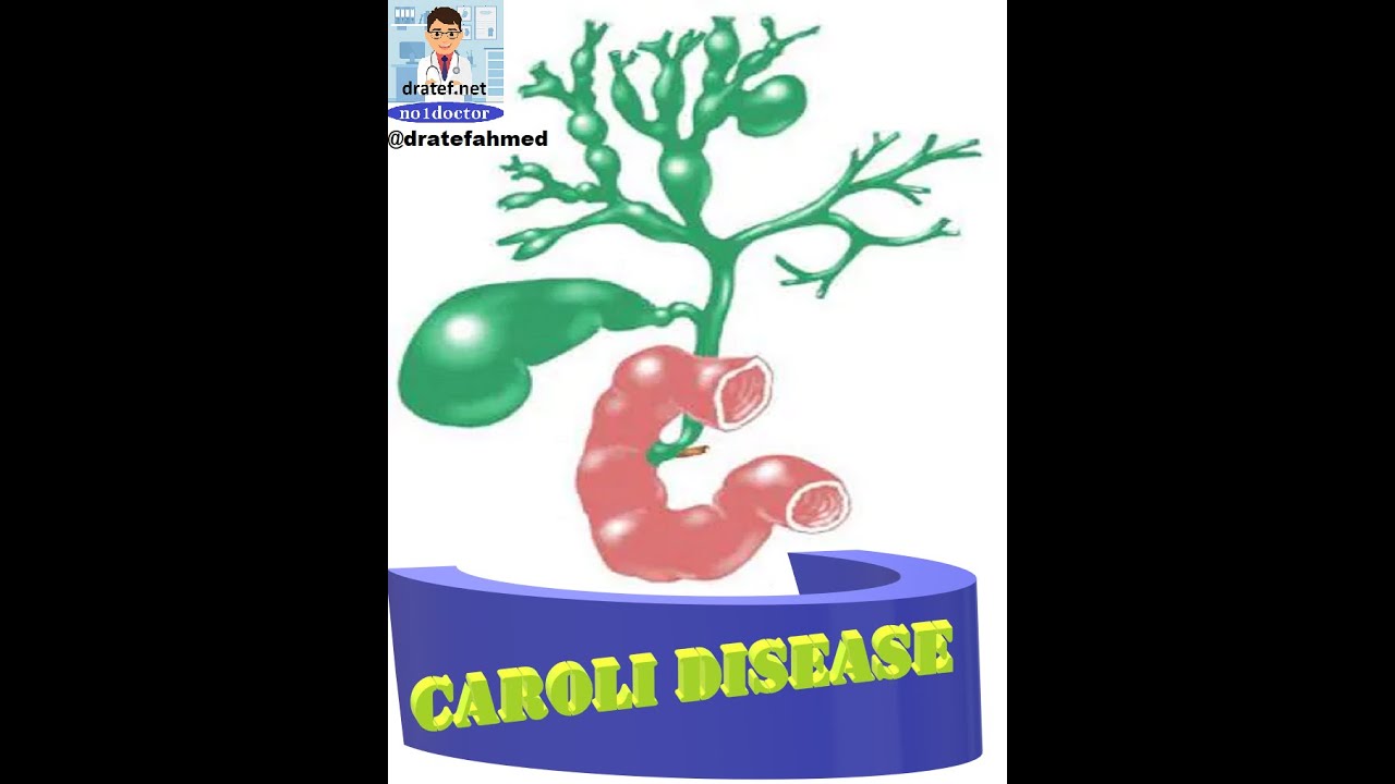 Caroli Disease /Caroli&rsquo;s Syndrome / Caroli&rsquo;s Disease/ Cogenital Biliary Disease / choledochal cyst