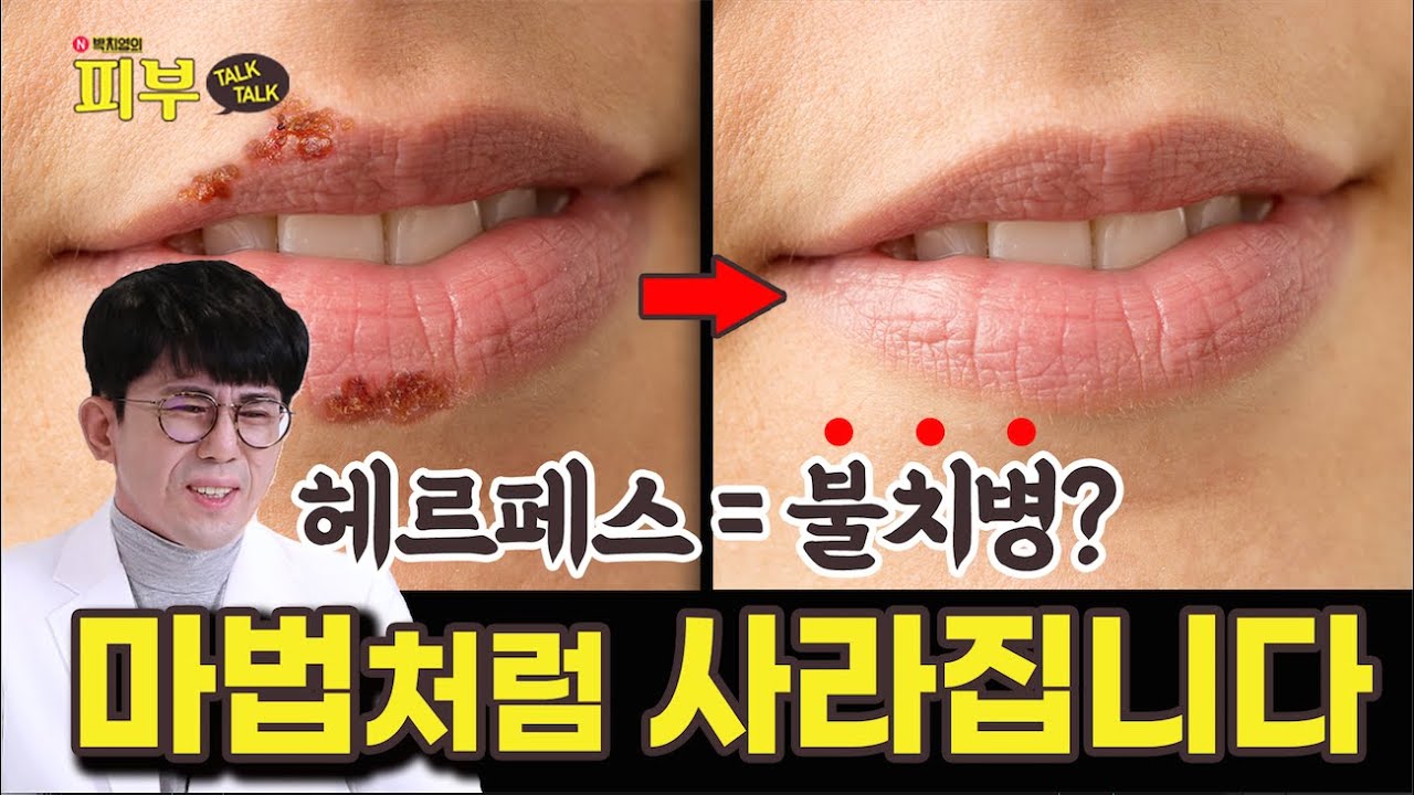 입술 포진 자주 재발하는 분들은 꼭 보세요! 헤르페스 바이러스의 특징과 관리법 - 박치영의 피부 톡톡 #152
