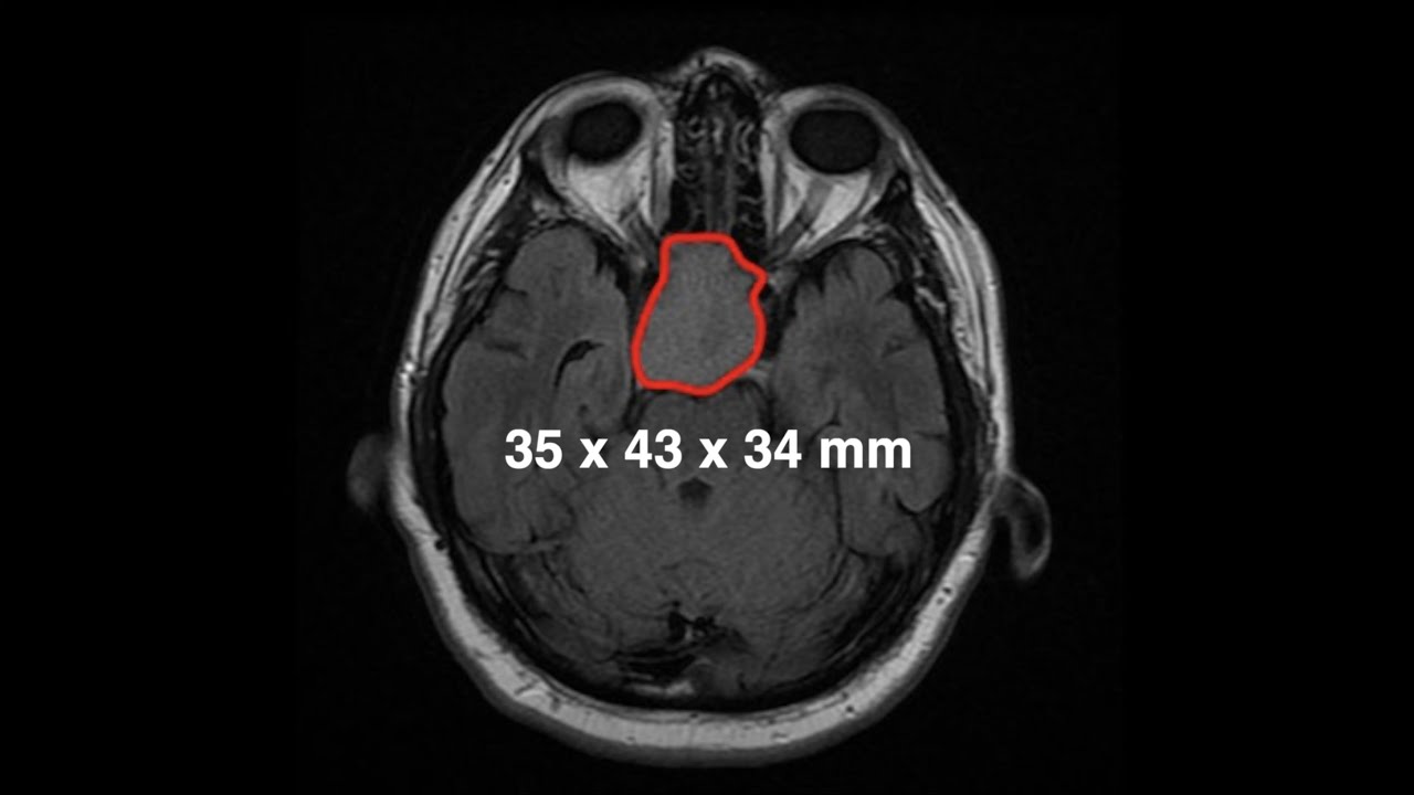 Macroadenoma de hipófisis (tumor de gran tamaño)
