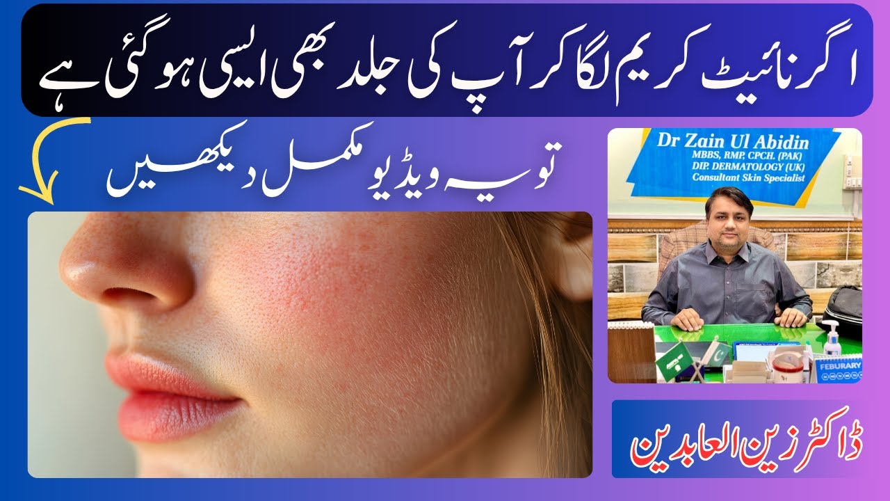 The 5-Minute FIX for Face Redness and Spider Veins at Home