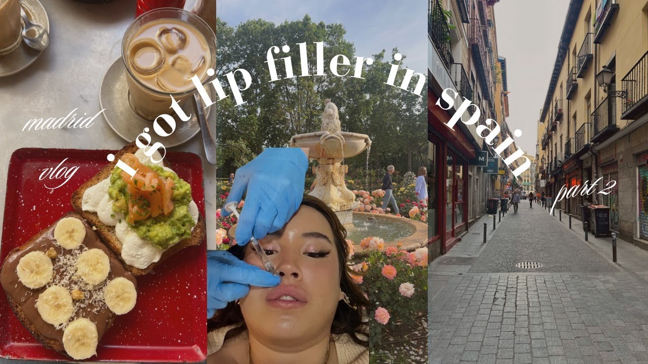 i got lip filler in spain!