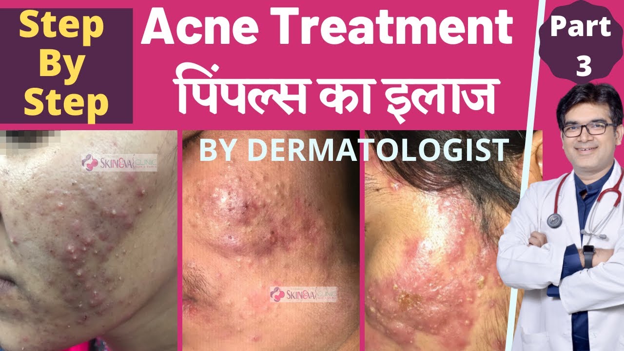 Acne Treatment By Dermatologist In Hindi | Pimples का इलाज | Acne Treatment Medicines | Dr Sunil