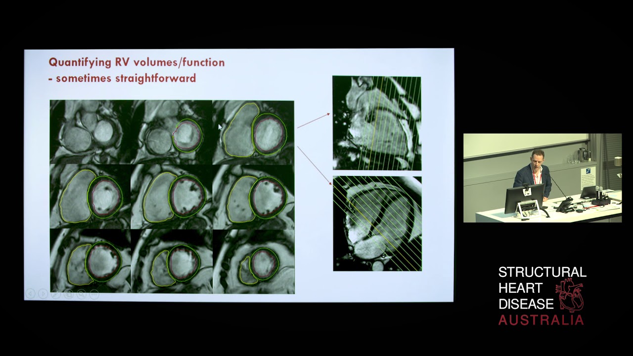 MRI of the Right Heart - Dr Imre Hunyor