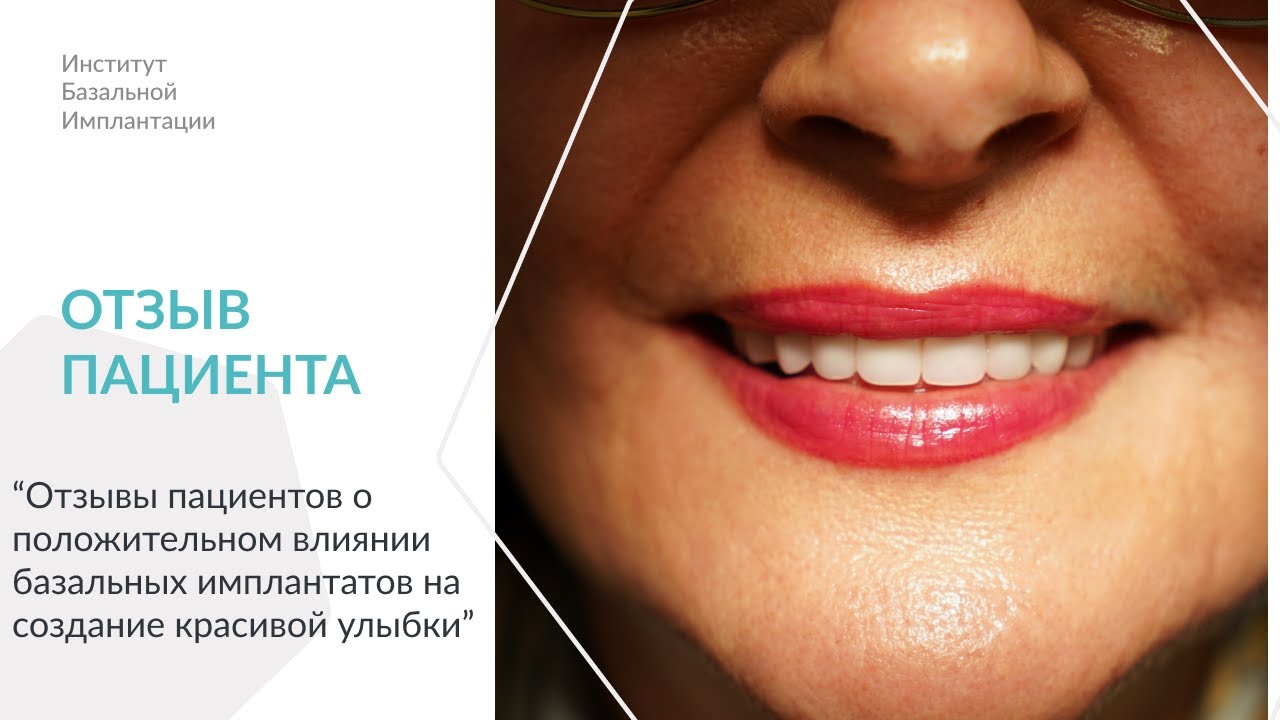 ОТЗЫВ ПАЦИЕНТА/ПОСТОЯННЫЕ ЗУБЫ НА СЛЕДУЮЩИЙ ДЕНЬ! ЭТО РЕАЛЬНО?