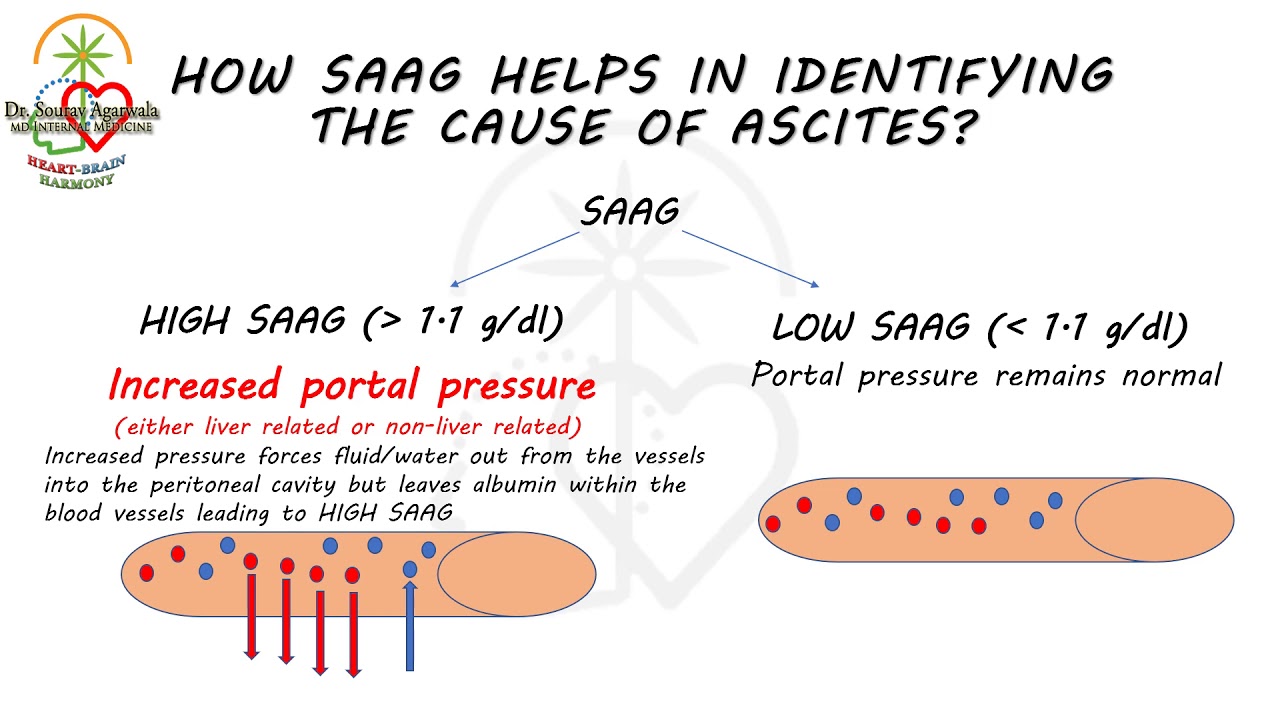 SAAG : SERUM ASCITES ALBUMIN GRADIENT | HARRISON BASED EXPLANATION IN LESS THAN 5 MINUTES !!!