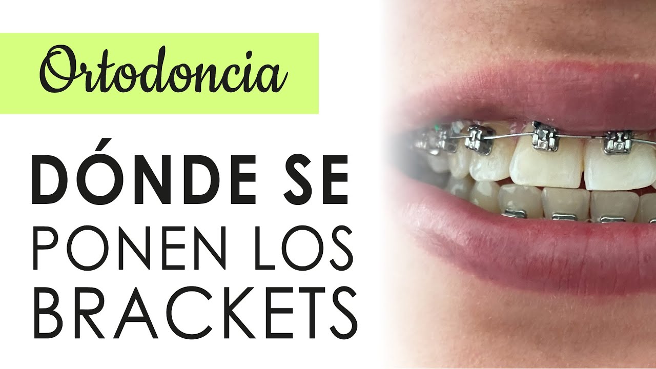¿DÓNDE SE PONEN LOS BRACKETS? | UBICACIÓN DEL BRACKET EN EL DIENTE