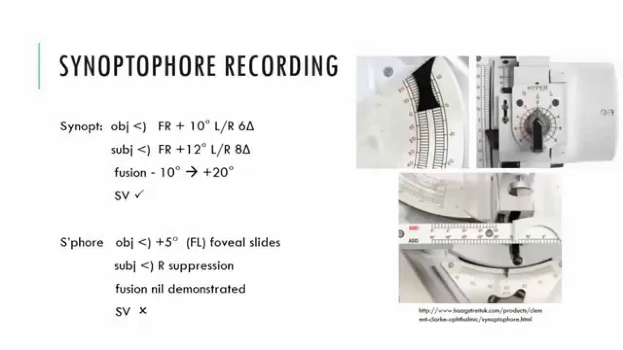Synoptophore: Assessment of BSV